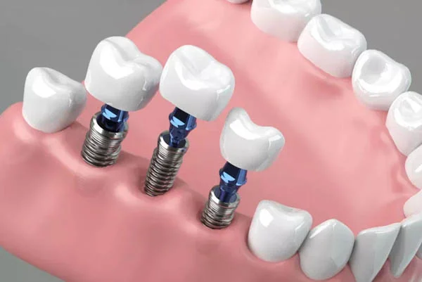 Dental Implants