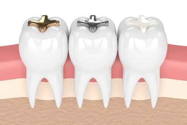 Dental Fillings