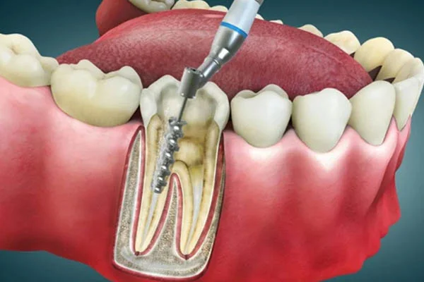 Root Canal Treatment