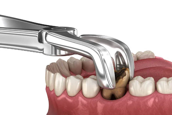 Tooth Extraction