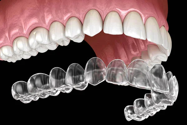 Clear Aligners