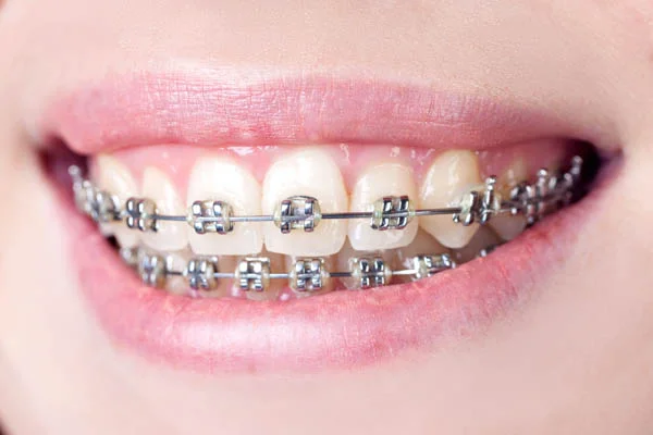 Dental Braces
